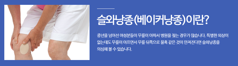 슬와낭종(베이커낭종)이란? 중년을 넘어선 여성분들이 무릎이 아파서 병원을 찾는 경우가 많습니다. 특별한 외상이 없는데도 무릎이 아프면서 무릎 뒤쪽으로 물혹 같은 것이 만져진다면 슬와낭종을 의심해 볼 수 있습니다.