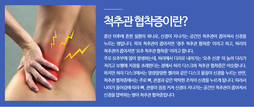 척추관 협착증이란? 중년 이후에 흔한 질환의 하나로, 신경이 지나가는 공간인 척추관이 좁아져서 신경을 누르는 병입니다. 목의 척추관이 좁아지면 '경추 척추관 협착증' 이라고 하고, 허리의 척추관이 좁아지면 '요추 척추관 협착증' 이라고 합니다. 
주로 요추부에 많이 발생하는데, 허리에서 다리로 내려가는 '요추 신경' 이 눌려 다리가 저리고 보행에 지장을 초래한다는 점에서 허리 디스크와 척추관 협착증은 비슷합니다. 하지만 허리 디스크에서는 말랑말랑한 젤리와 같은 디스크 물질이 신경을 누르는 반면, 척추관 협착증에서는 주로 뼈, 관절과 같은 딱딱한 조직이 신경을 누르게 됩니다. 따라서 나이가 들어감에 따라 뼈, 관절이 점점 커져 신경이 지나가는 공간인 척추관이 좁아져서 신경을 압박하는 병이 척추관 협착증입니다.